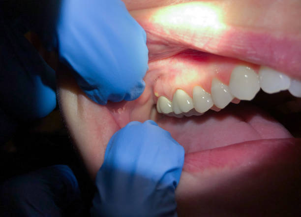 Best Emergency Tooth Extraction in Clymer, PA